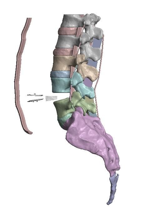 Spinal implant model for orthopaedic planning